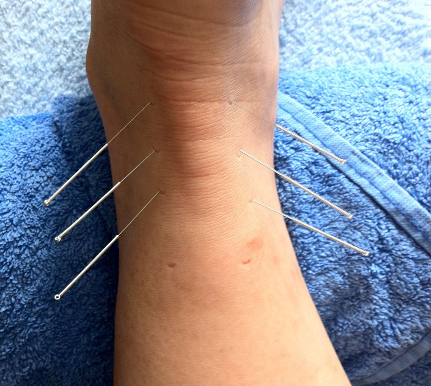 Acupuncture
